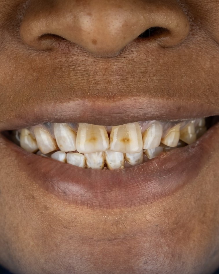 Dental implants